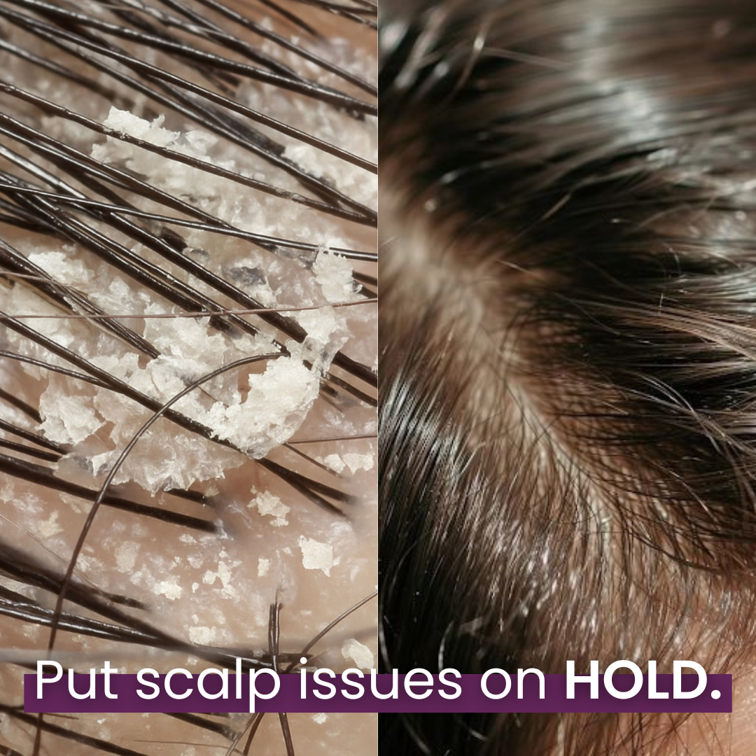 Biotin + Collagen ScalpRenew™ Treatment